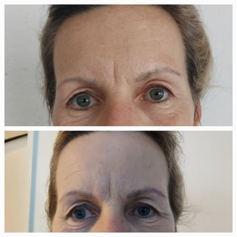 Ergebnisse OHNE FILTER von der ersten GESICHT Behandlung