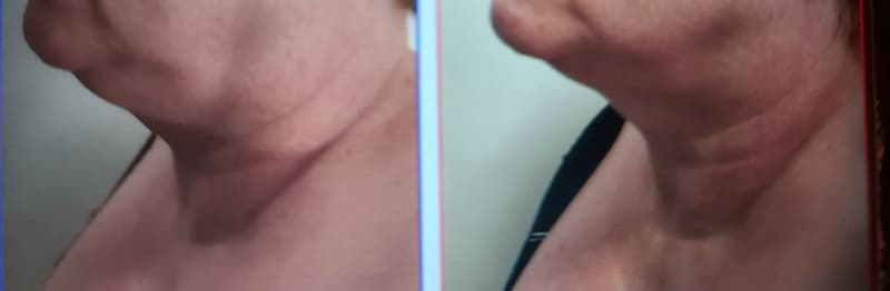 Ergebnisse OHNE FILTER von der ersten GESICHT Behandlung